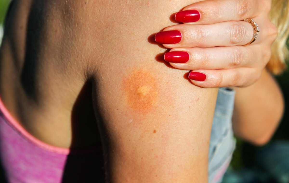 Essential oils for itchy bug bites - Cliganic